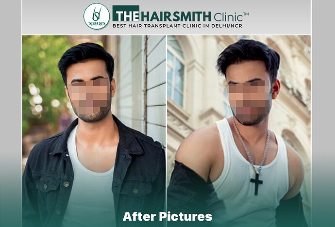 The HairSmith Clinic™ | NW Stage 3 | 2145 Grafts | 8 Months Hair Transplant Result photo