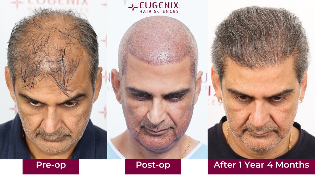 https://cdn.forumhairtransplant.com/optimized/3X/0/0/003e51b269a45ea110bfbf915a41d21cf72e1618_2_1035x582.jpeg