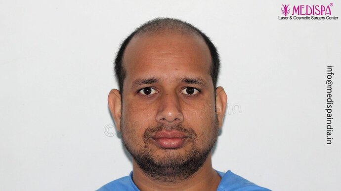 Dr. Suneet Soni - 4500 Grafts, Combine FUT + FUE Technique, NW-III photo