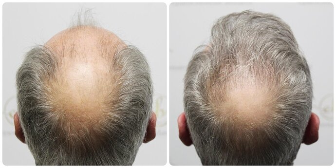 Dr Bonaros, Glasgow, UK / 3524 FUE grafts / 0-12 Months photo