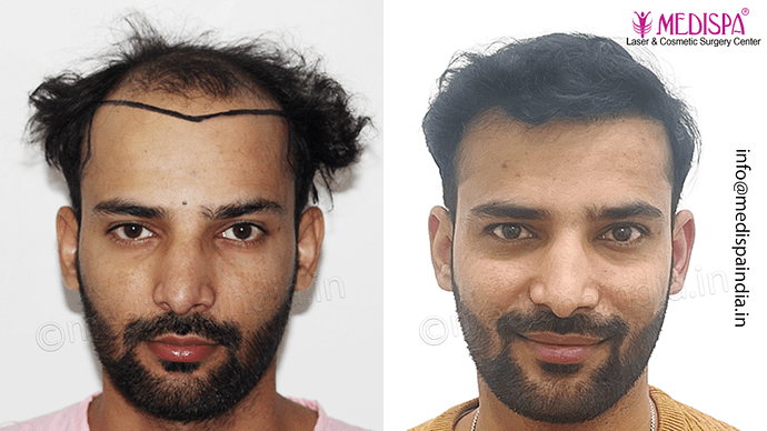 Dr. Suneet Soni - 4046 Grafts | 12-Month Result | Combination FUT + FUE + Beard photo