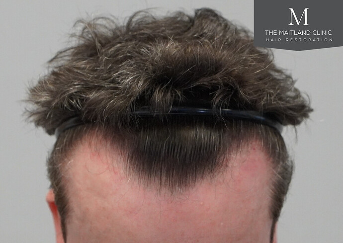 Before and after results: 1694 grafts by FUE at The Maitland Clinic (Dr Edward Maitland Ball) photo