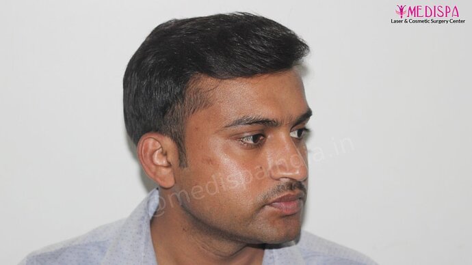 Dr. Suneet Soni - 5587 Grafts, Combine FUT + FUE + Beard Technique, NW : V-VI photo