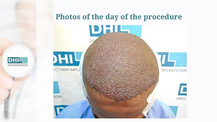 DHI India | NW Scale 6 | 4,127 Grafts | 9 Months DHI Hair Transplant Result photo