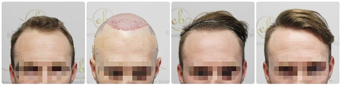Dr Bonaros, Glasgow, UK / 1819 FUE grafts / 0-12 Months photo