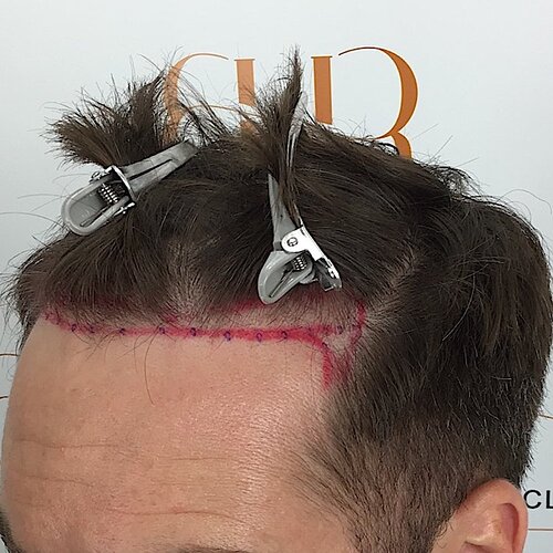 Dr. Bisanga & Dr. Kostis - 2955 FUE - 9 Months - Front & Crown photo