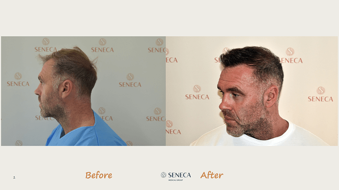 Seneca Medical Group - 2300 grafts with Direct Fue photo