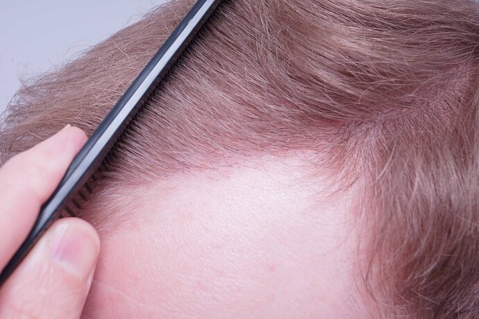 Dr B Farjo 1820 FUE (Fontal) Very early growth. photo