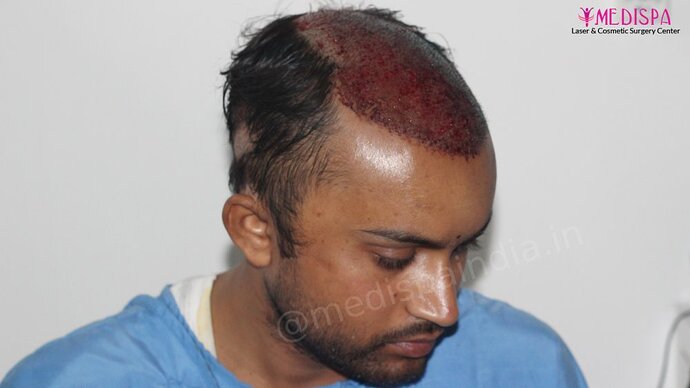 Dr. Suneet Soni - 5587 Grafts, Combine FUT + FUE + Beard Technique, NW : V-VI photo
