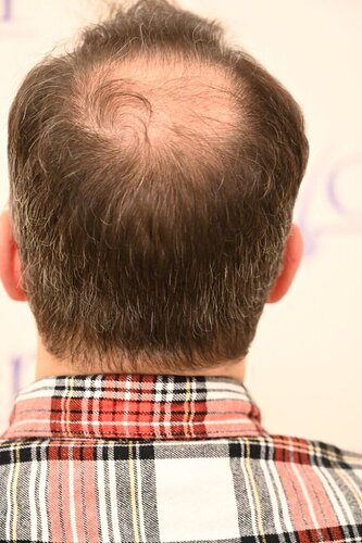 Ozlem Bicer MD-Hair Transplant-3870 Grafts FUE by micro-motor, 5. months result photo