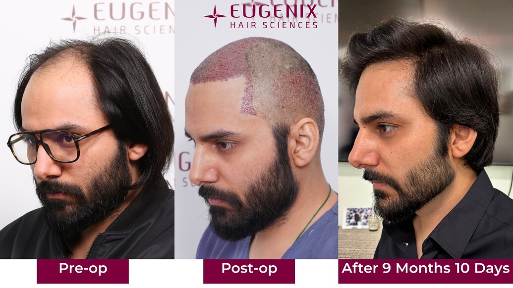 https://cdn.forumhairtransplant.com/optimized/3X/0/1/016d62d1fe3001680d6a14cd858c451e7e4c8369_2_1035x582.jpeg