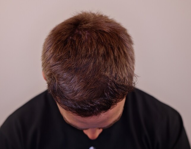 Dr. Barton Hair Transplant Result 2,500 grafts photo