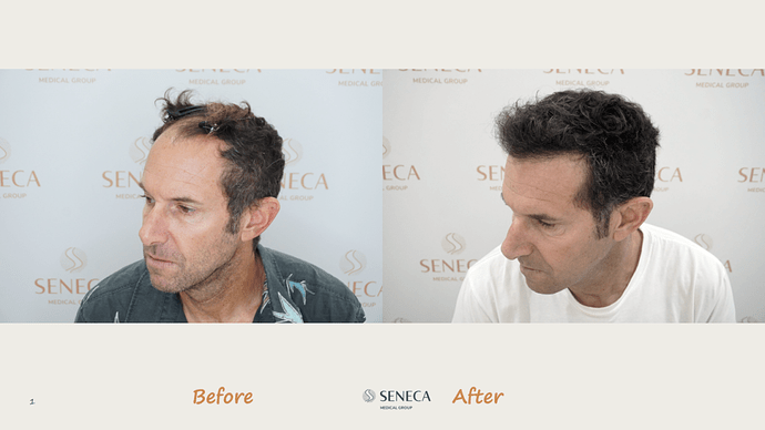 Seneca Medical Group - 1700 grafts with Direct Fue photo