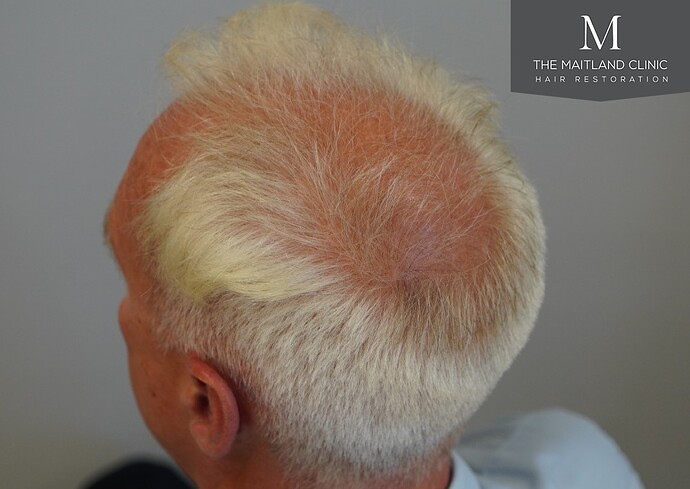 Dr Ball - The Maitland Clinic 2280 Grafts by FUE photo