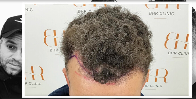 Dr.Bisanga, BHR Clinic 1489 FUE 0 - 5 Months Fast Growth Curly Hair photo