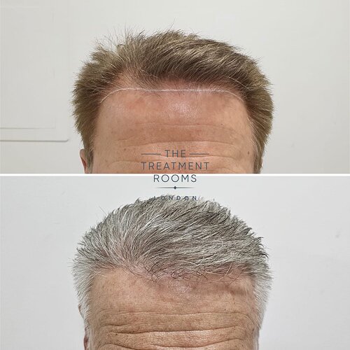 2129 Grafts Hairline, Temples and Crown Restoration photo