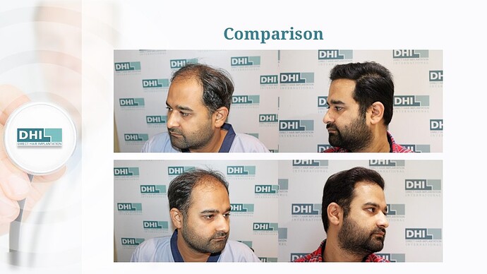 Full Scalp Coverage – 3,636 Grafts | DHI India Result photo