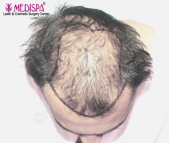 Dr. Suneet Soni - 5000 Grafts, Combine FUT + FUE + Beard, Natural Hairline photo