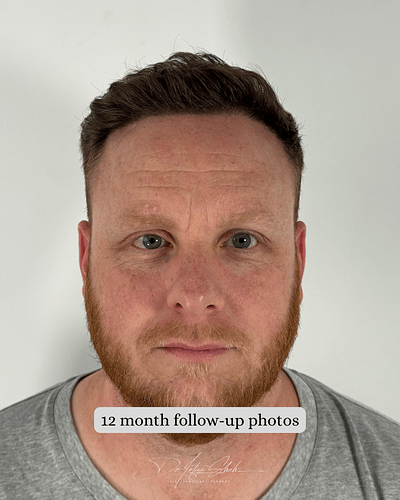 Dr Shah (London, UK) 3114 FUE grafts (0-12 months) photo