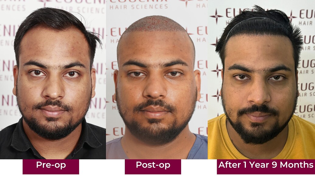 https://cdn.forumhairtransplant.com/optimized/3X/0/2/02862b7073606b8157d29e1bbdec596a38df9d44_2_1035x582.jpeg
