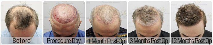 Dr Bonaros, Glasgow, UK / 3986 FUE grafts / 0-12 Months photo