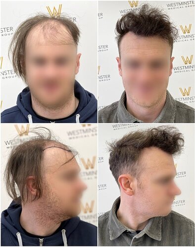 Westminster Medical Group London - 2897 Grafts - 12 Months Progress photo