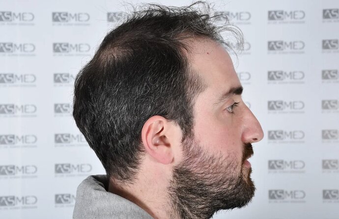 ASMED CLINIC CASE - DR.KORAY 5000 GRAFTS FUE photo