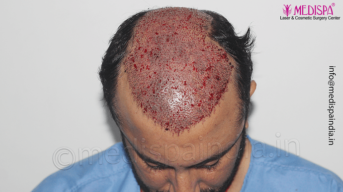 Dr. Suneet Soni - 5334 Grafts, Combine FUT + FUE + BHT (Beard) Technique, NW- V photo