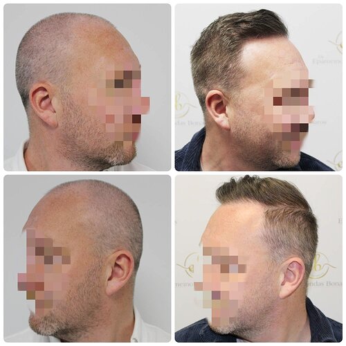 Dr Bonaros, Glasgow, UK / 4076 FUE grafts / 0-12 Months photo