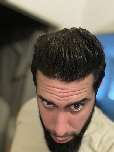 Dr Fares Seffen (Tunis, Tunisia) 3760 FUE results (Diffuse NW 4) Day 0 --> 10 Months after photo