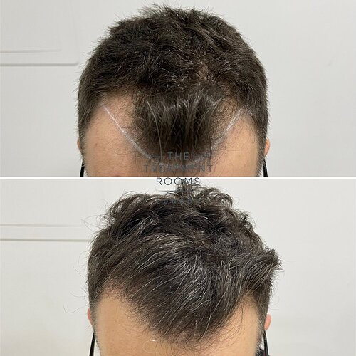 Hairline FUE hair transplant -1321 grafts photo