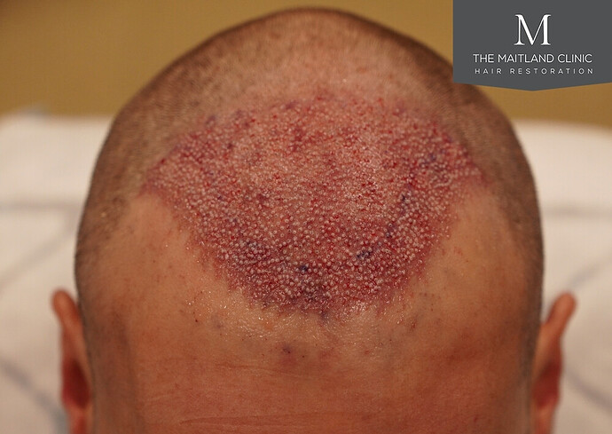 1826 grafts by FUE with Dr Edward Maitland Ball at The Maitland Clinic photo