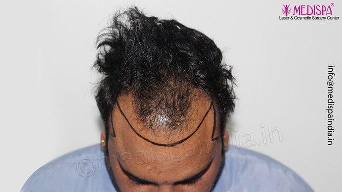 Dr. Suneet Soni - 4500 Grafts, 3 Year Result, NW-IV, Combine FUT + FUE Technique photo