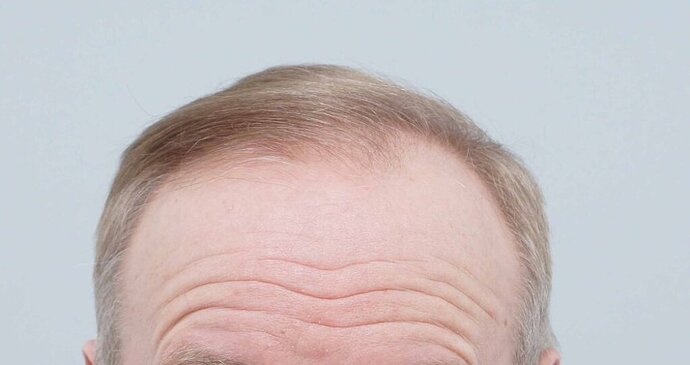 FUE Hair Transplant - Dr B Farjo - 2510 Grafts photo