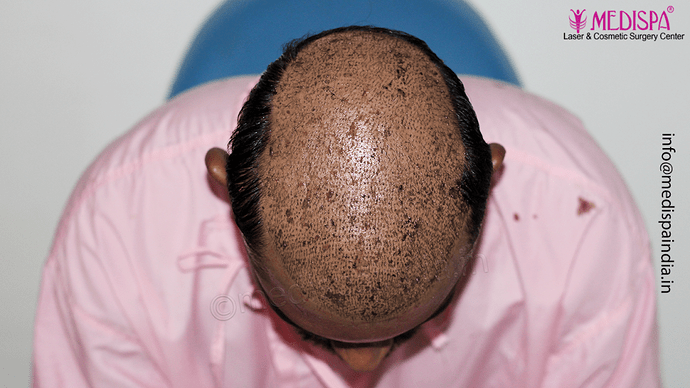 Dr. Suneet Soni - 5360 Grafts | 12-Month Result | Combination FUT + FUE + Beard photo