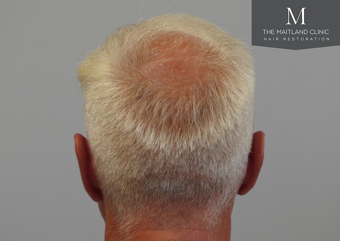 Dr Ball - The Maitland Clinic 2280 Grafts by FUE photo