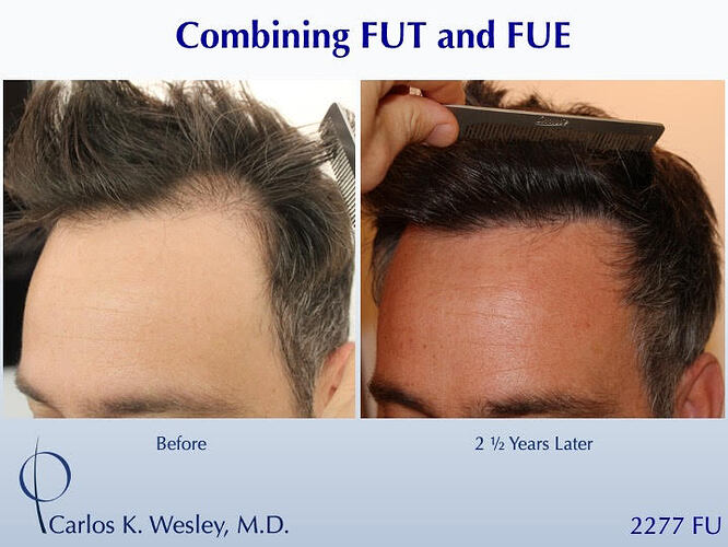 #BAM Most Natural Hairline (2277 FUE and FUT grafts): Carlos K. Wesley, M.D. (NYC & LA) photo