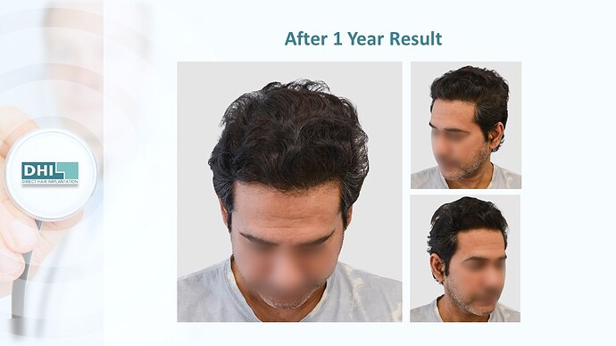 DHI India™ | NW 4 | 3,759 Grafts | 1 year DHI Hair Transplant Results photo