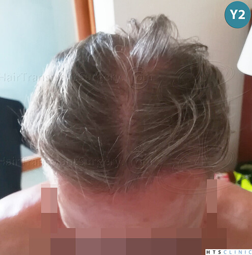 Dr Devroye + Dr Montesanti + Dr Jenard / 7015 grafts (4512 FUT + 2503 FUE) / 2 sessions photo