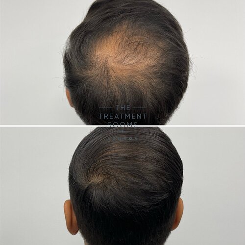 1411 Grafts Hairline and Crown Result- The Treatment Rooms London photo