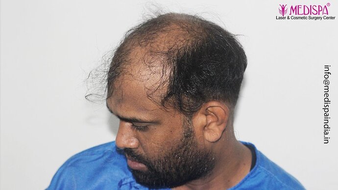 Dr. Suneet Soni - 5498 Grafts, 2 Years Result, Combine FUT + FUE + Beard Technique, NW-VI photo