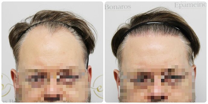 Dr Bonaros, Glasgow, UK / 3207 FUE grafts / 0-12 Months photo