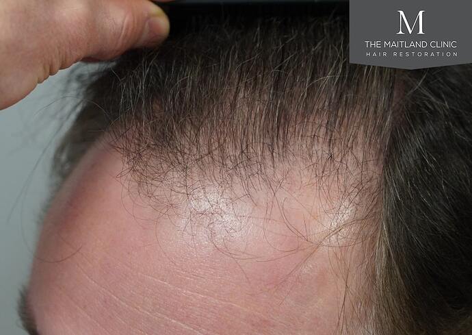 Dr Ball - The Maitland Clinic 2032 Grafts By FUE photo