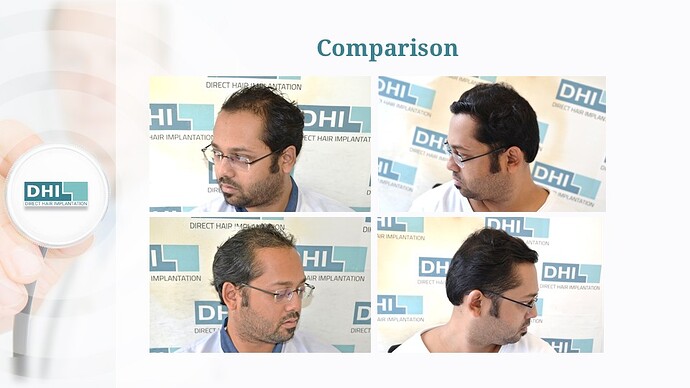 DHI India | NW Scale 5 | 4,353 Grafts | 07 Months DHI Hair Transplant Result photo