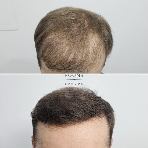 Hair Transplant Repair- 1733 Grafts photo