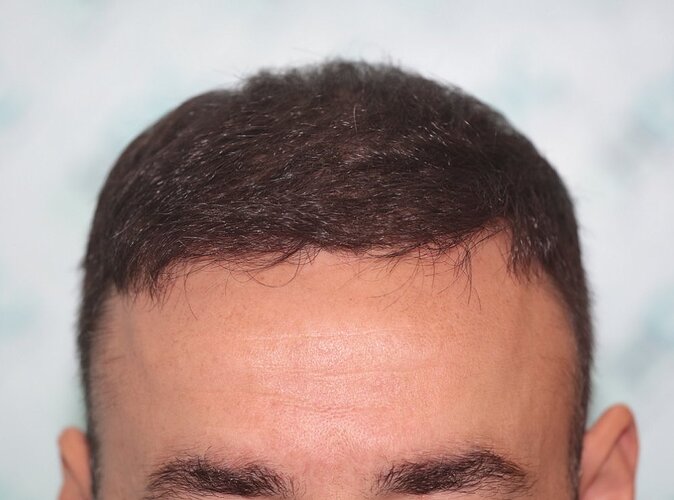 Two FUE Surgeries Totaling 6560 Grafts – HDC Hair Clinic photo