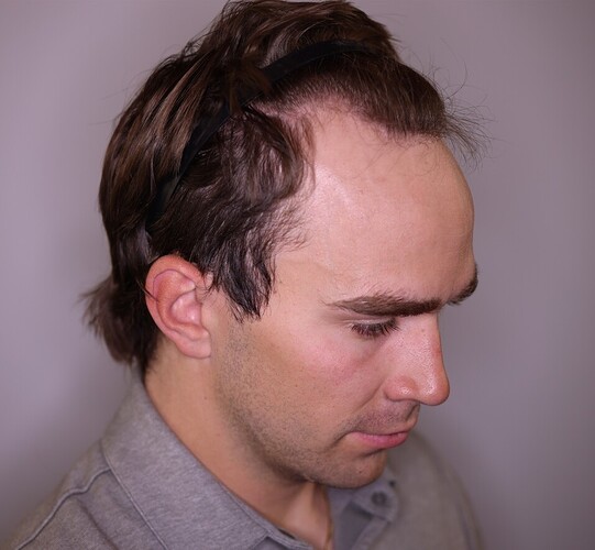 Dr. Barton Hair Transplant Result 2,500 grafts photo