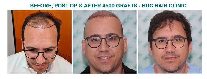 HDC Hair Clinic – FUE Hair Transplant Result for 4534 Grafts photo