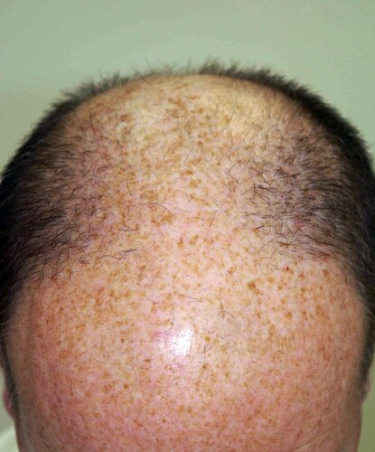 Dr B Farjo 2000-2023 Patient using both FUT and FUE, photo