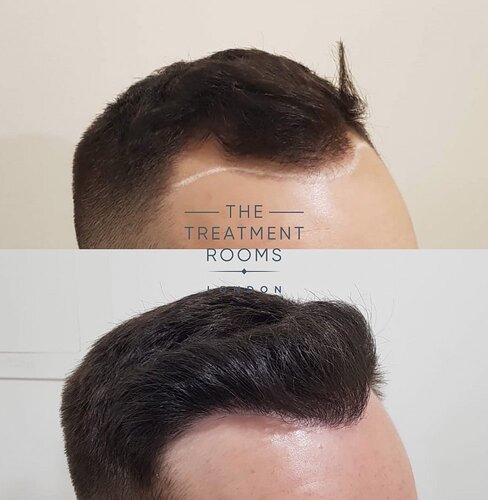 Before and after FUE Hair Transplantation 1292 Grafts photo